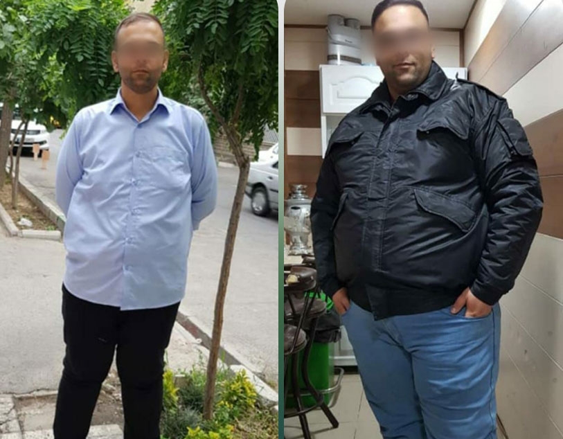 اسلیو معده
